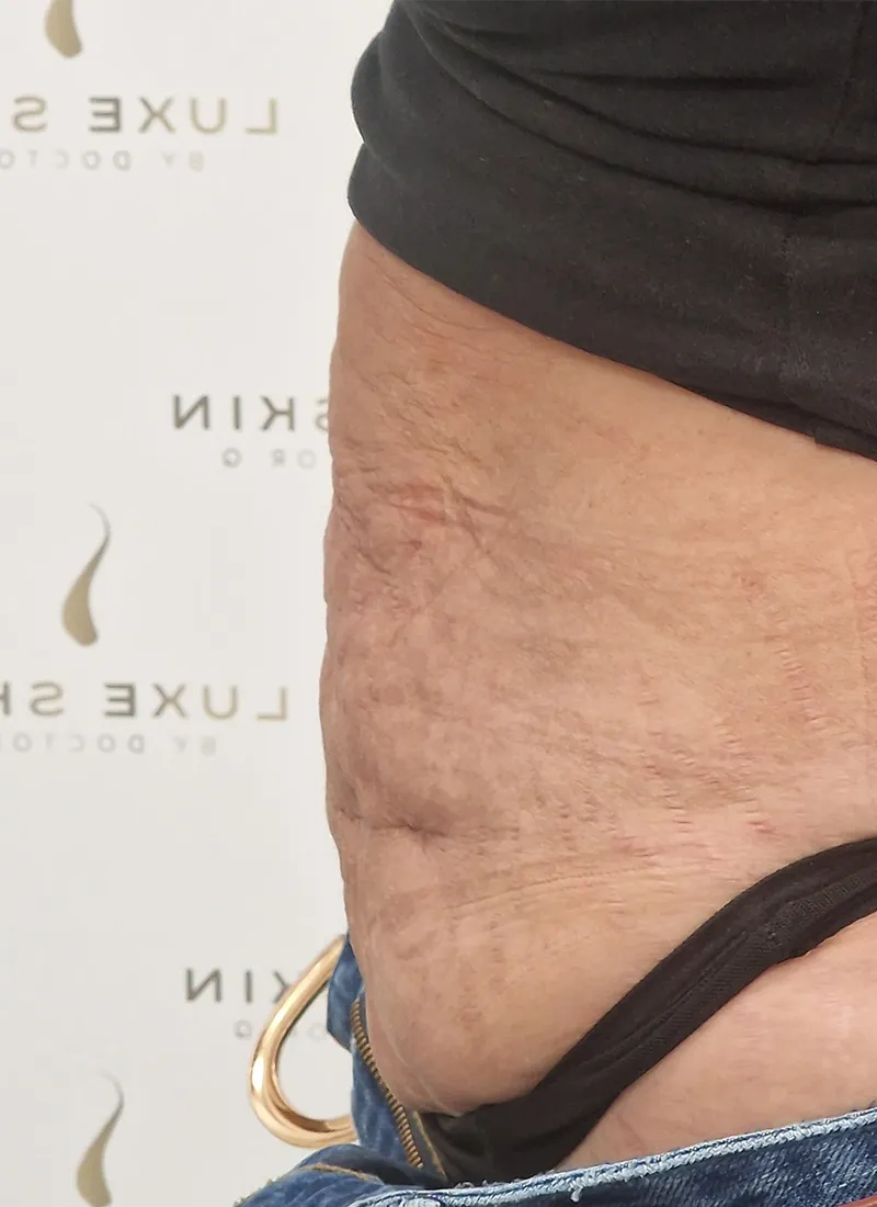 Bodytite After