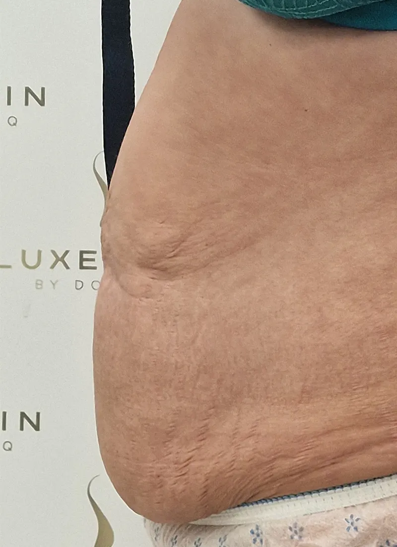 Bodytite Before