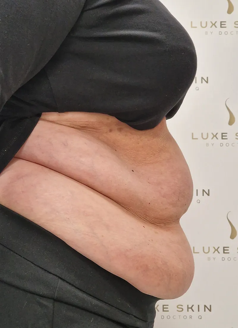 Non Surgical Liposuction Before treatment at Luxe Skin