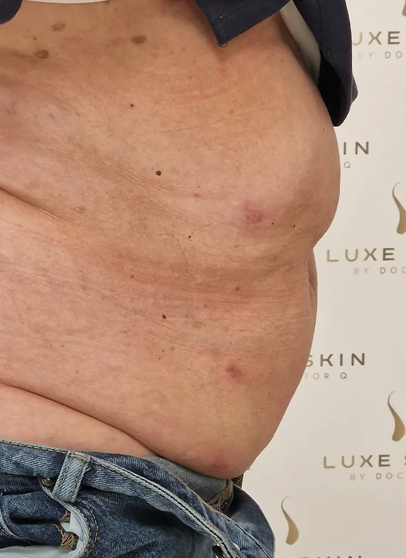 Non Surgical Liposuction After treatment at Luxe Skin