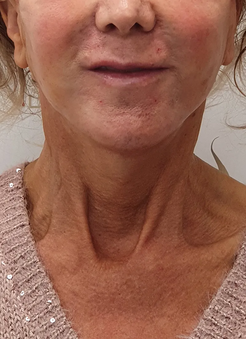 After the Necklift Treatment at Luxe Skin Glasgow