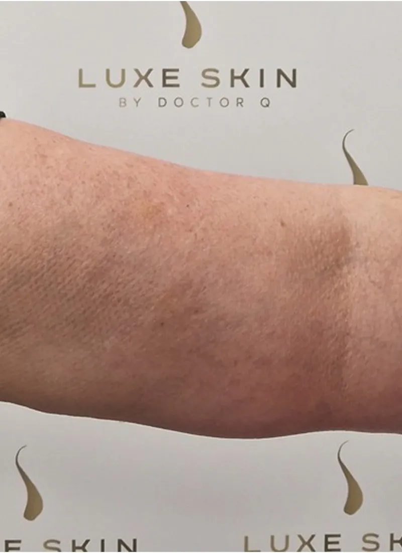 Arm Lift After Treatment at Luxe Skin Glasgow