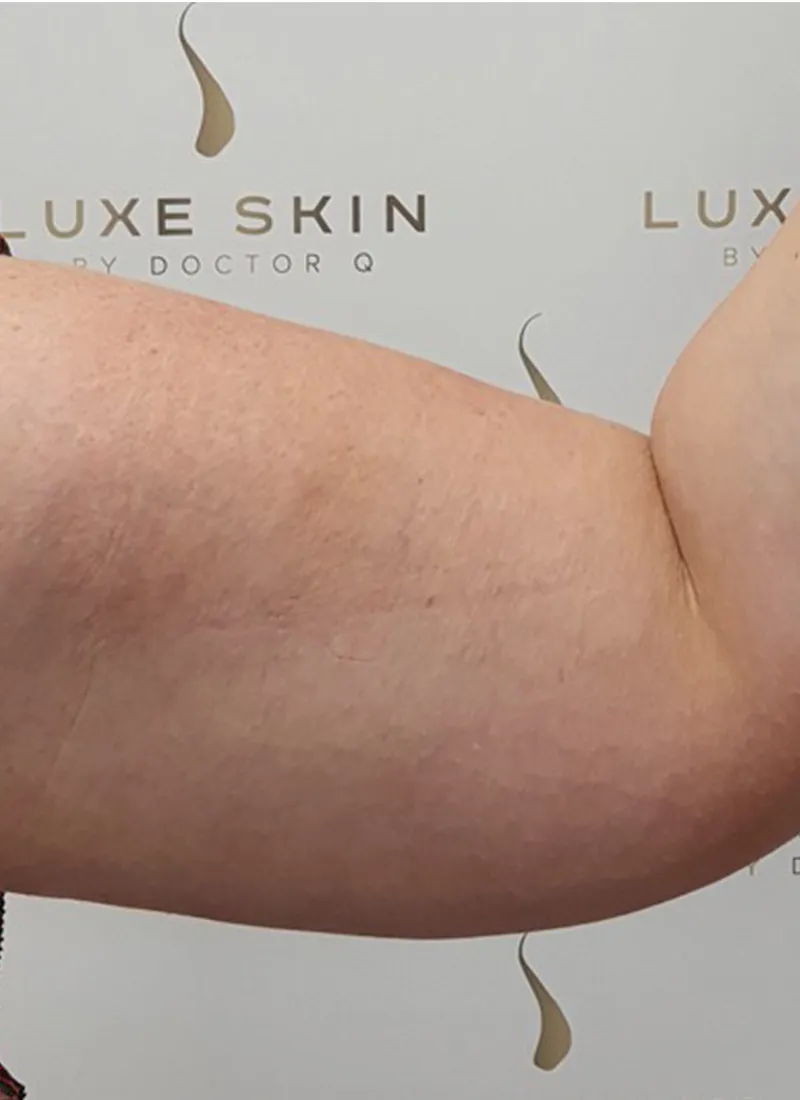 Arm Lift Before Treatment at Luxe Skin Glasgow