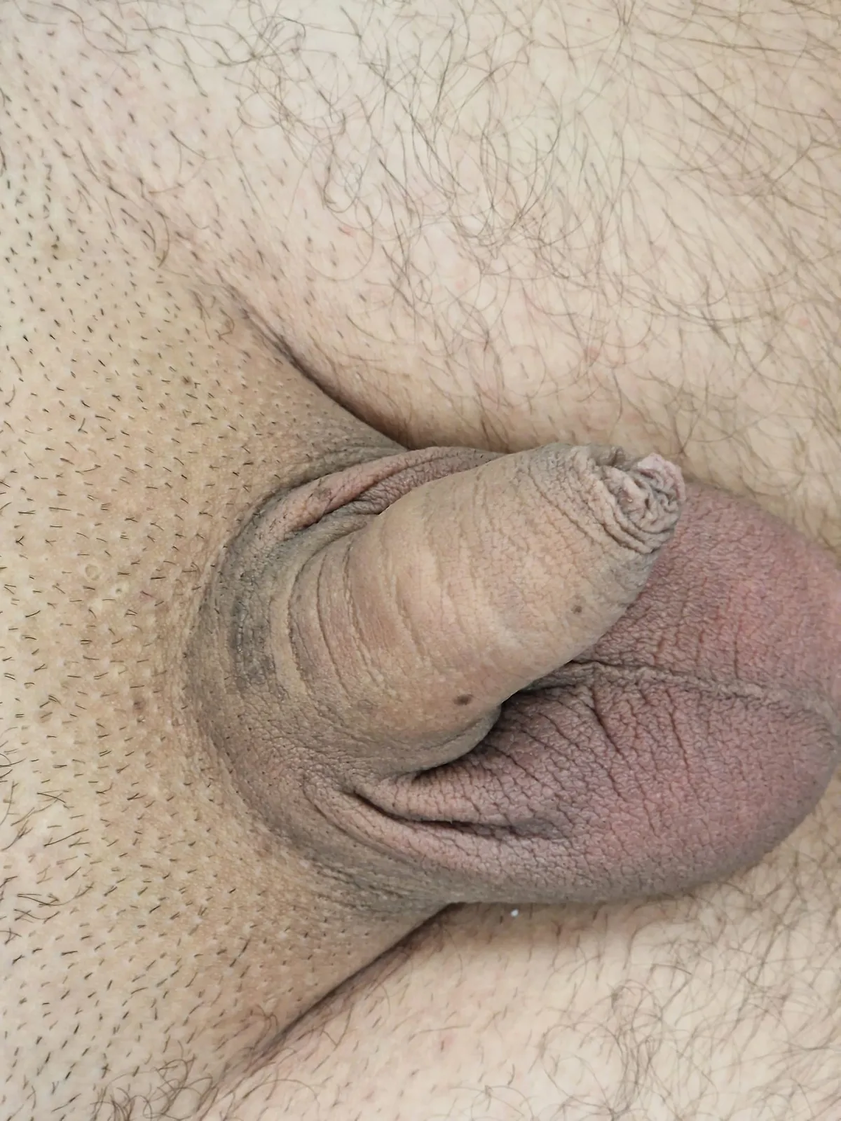 Before Penis Enlargement with Dr Q in Glasgow