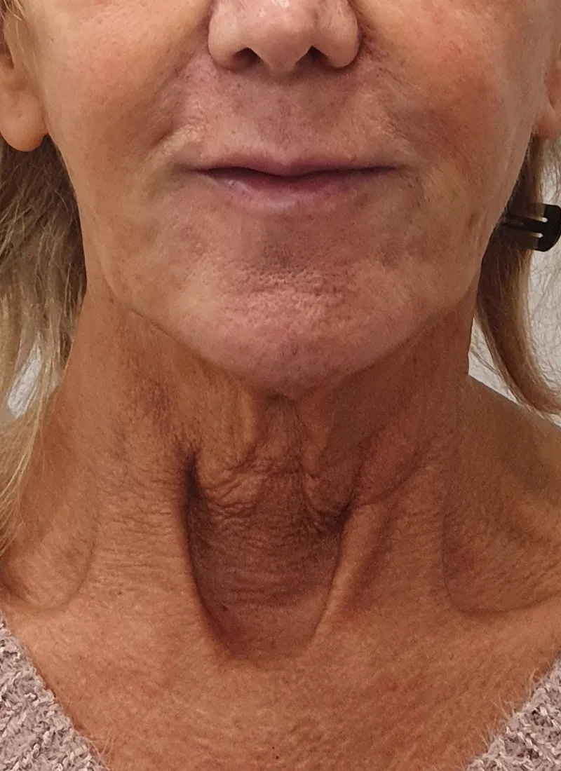 Before the Necklift Treatment at Luxe Skin Glasgow