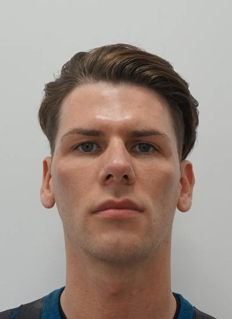 After Botox for Men at Luxe Skin Glasgow by Dr Q