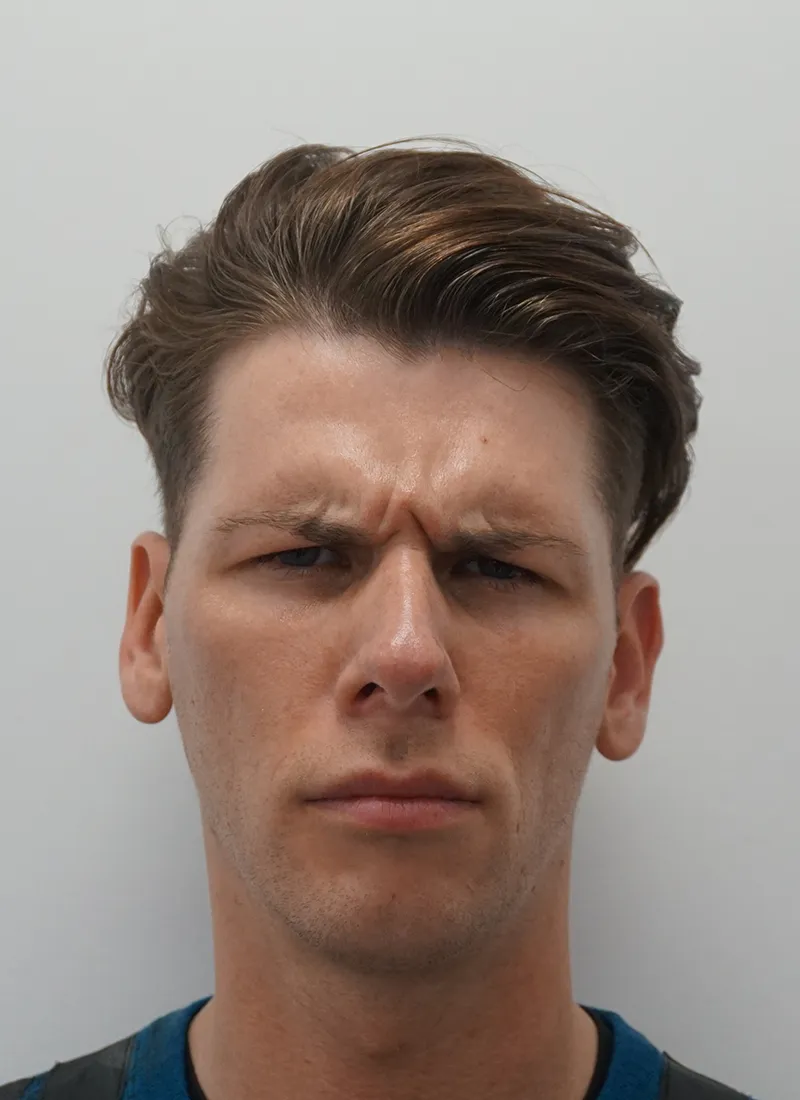 Before Botox for Men at Luxe Skin Glasgow by Dr Q