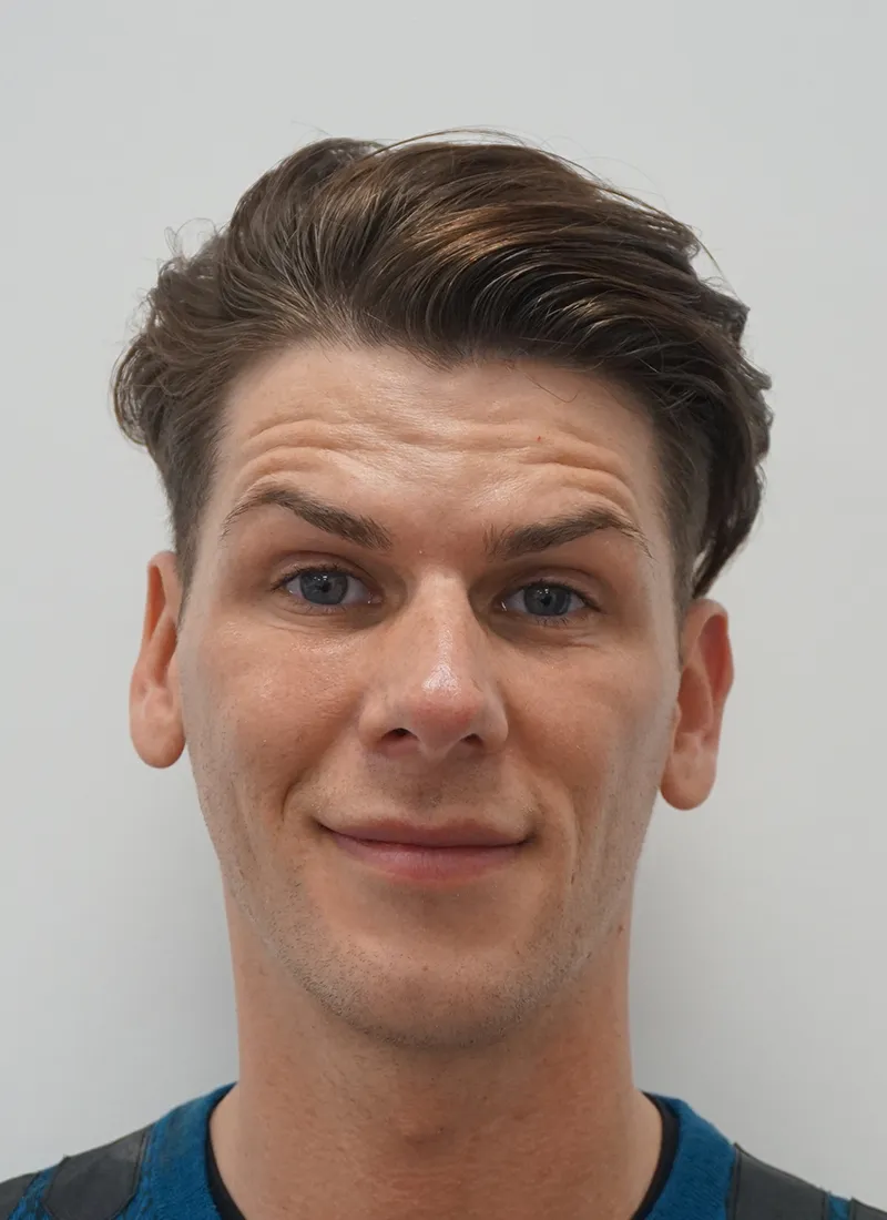 Botox for Men Before at Luxe Skin Glasgow