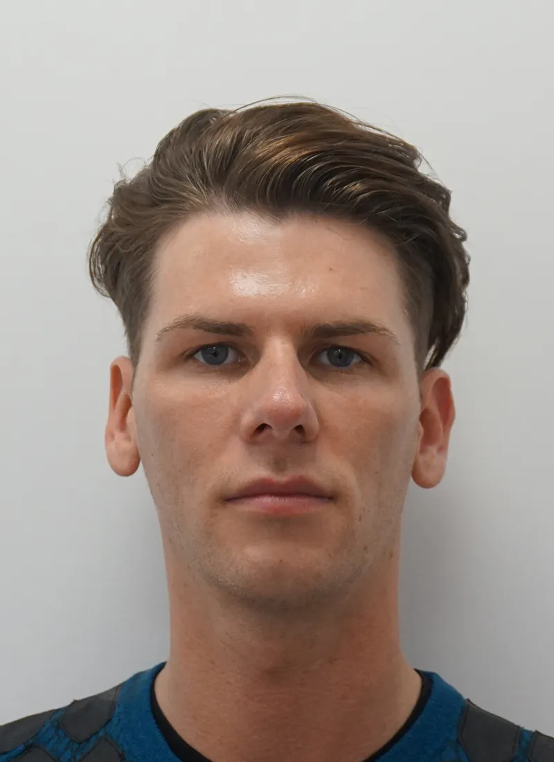 Botox for Men After at Luxe Skin Glasgow