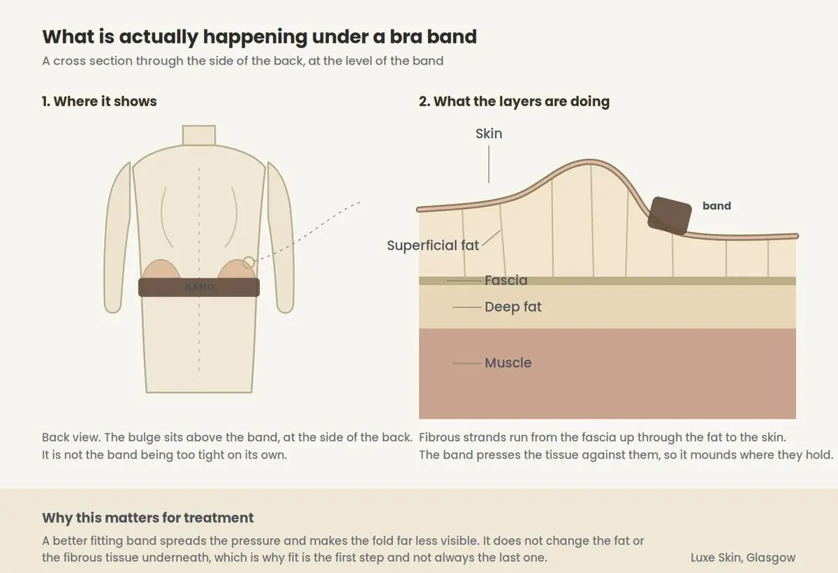 Labelled diagram of bra bulge: a back view showing the band across the back, and a cross section naming skin, superficial fat, fascia, deep fat and muscle