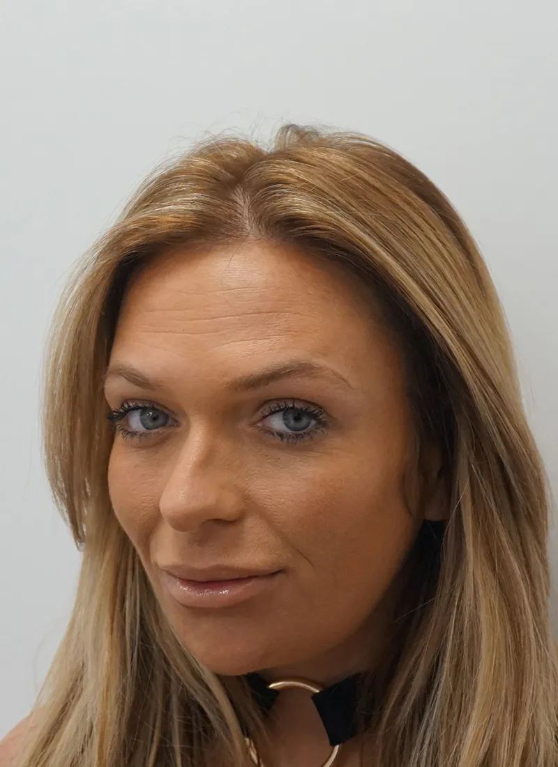 Botox After at Luxe Skin by Dr Q
