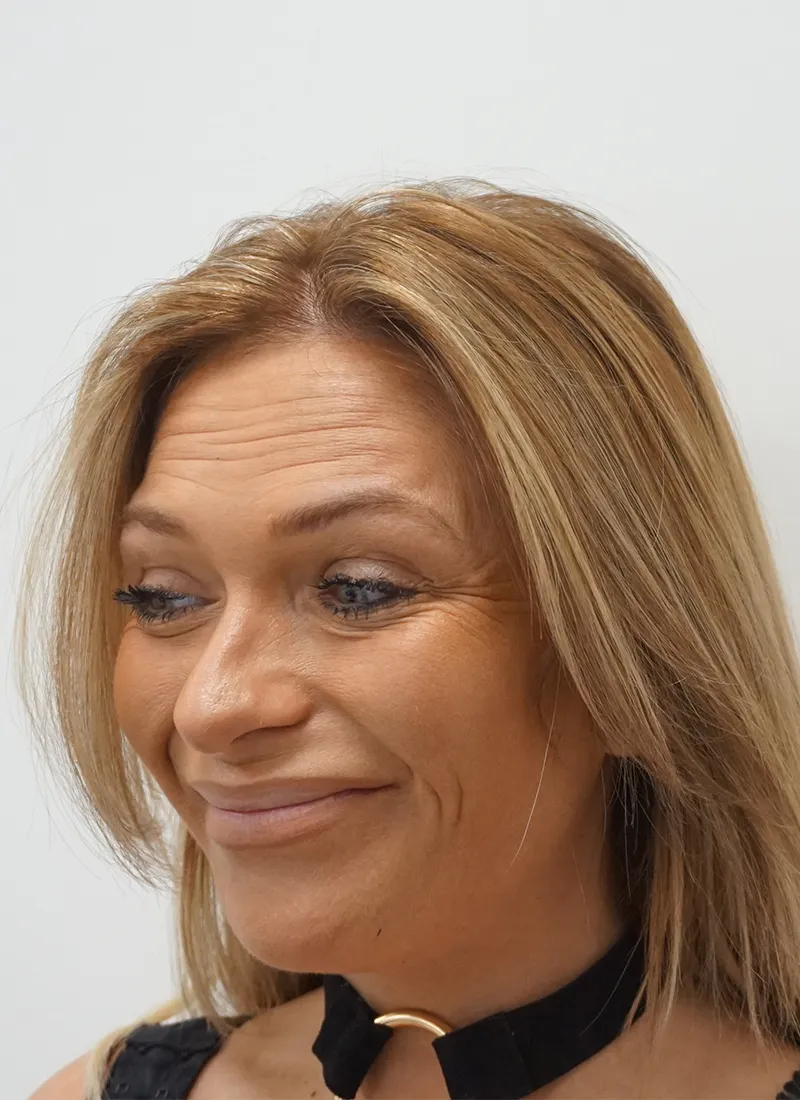 Botox Before at Luxe Skin by Dr Q