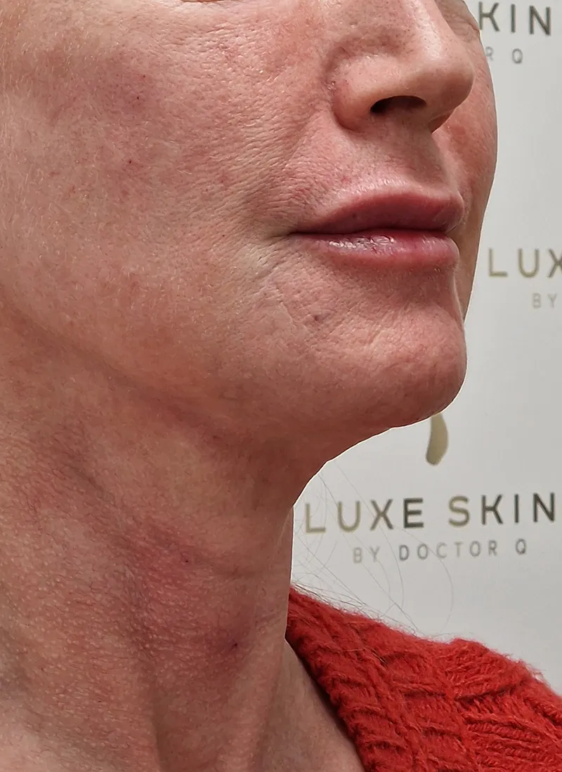 Dermal fillers after luxe skin by Dr Q