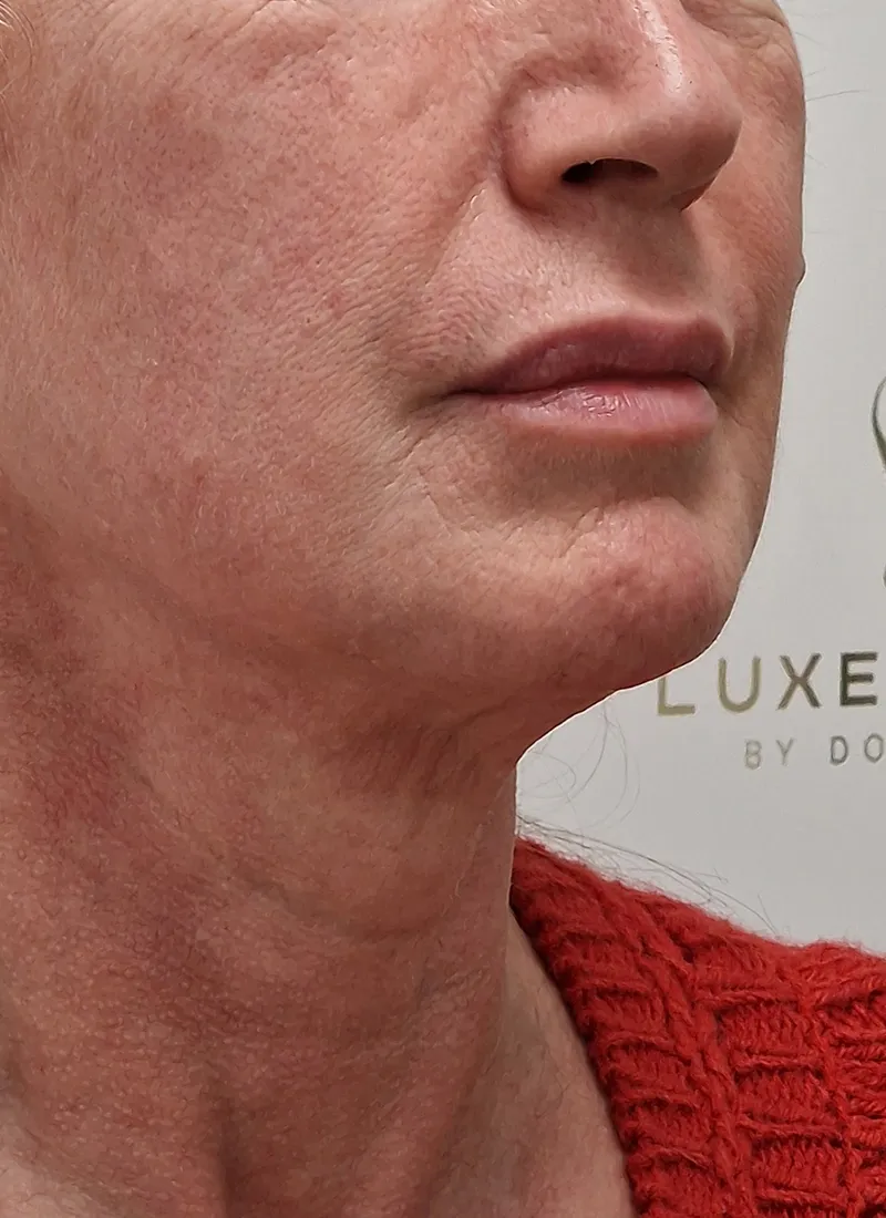 Dermal fillers before luxe skin by Dr Q