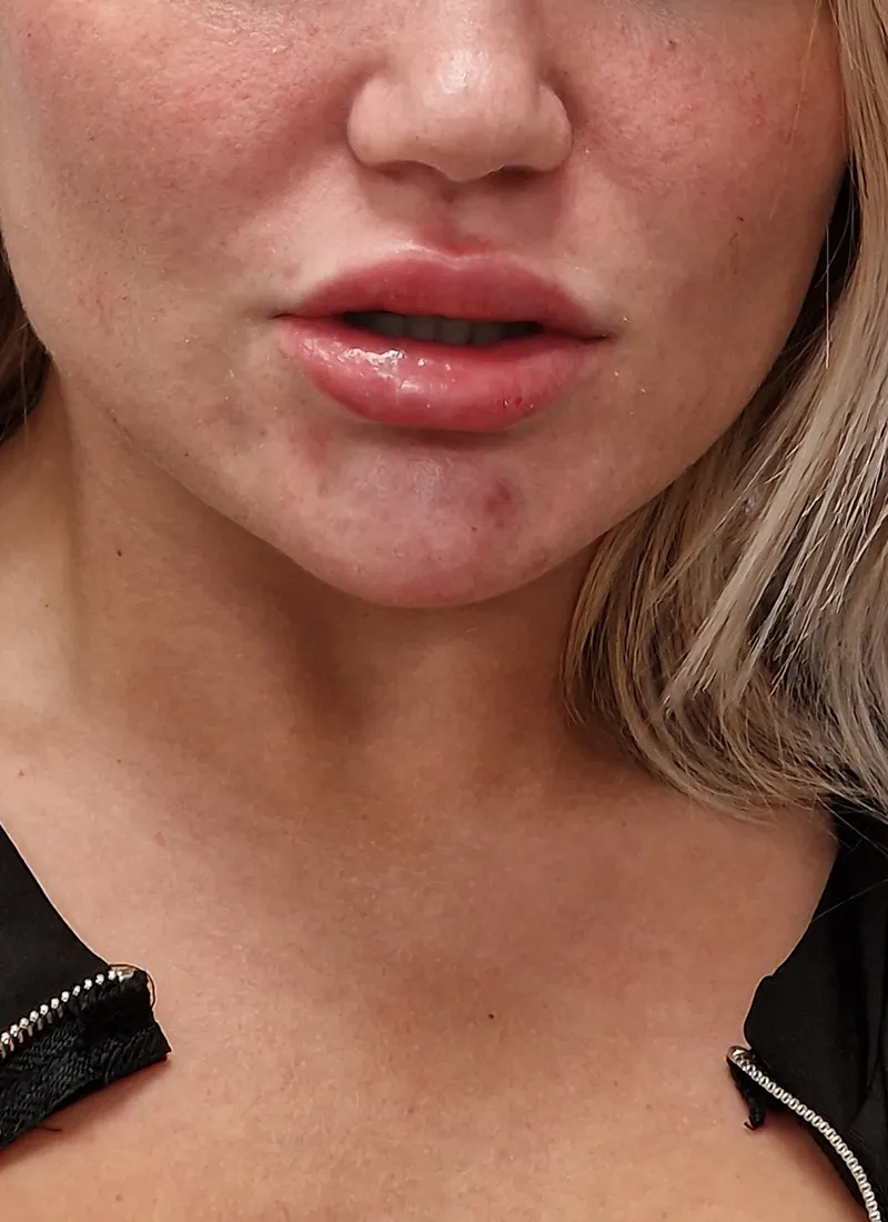 Dermal fillers facial profiling after at Luxe Skin Glasgow