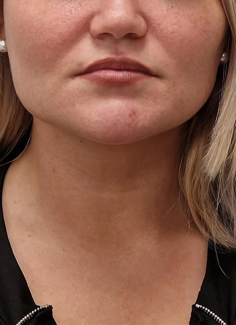 Dermal fillers facial profiling before at Luxe Skin Glasgow