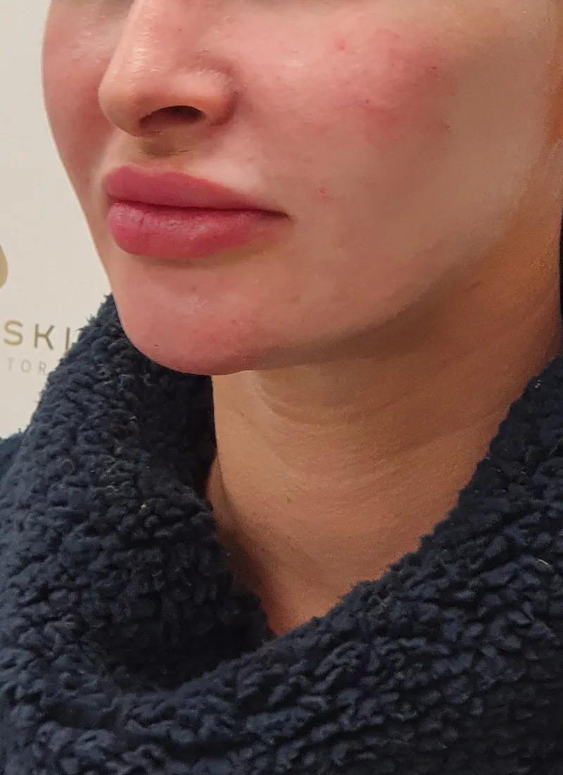 Dermal fillers after treatment by Dr Q