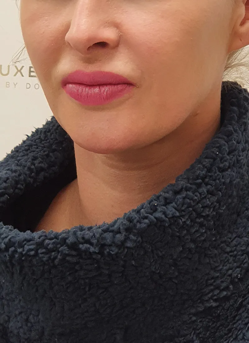 Dermal fillers before treatment at Luxe Skin Glasgow