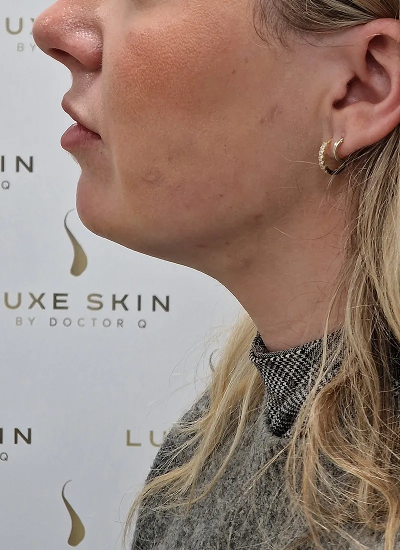 Double Chin after treatment by Dr Q