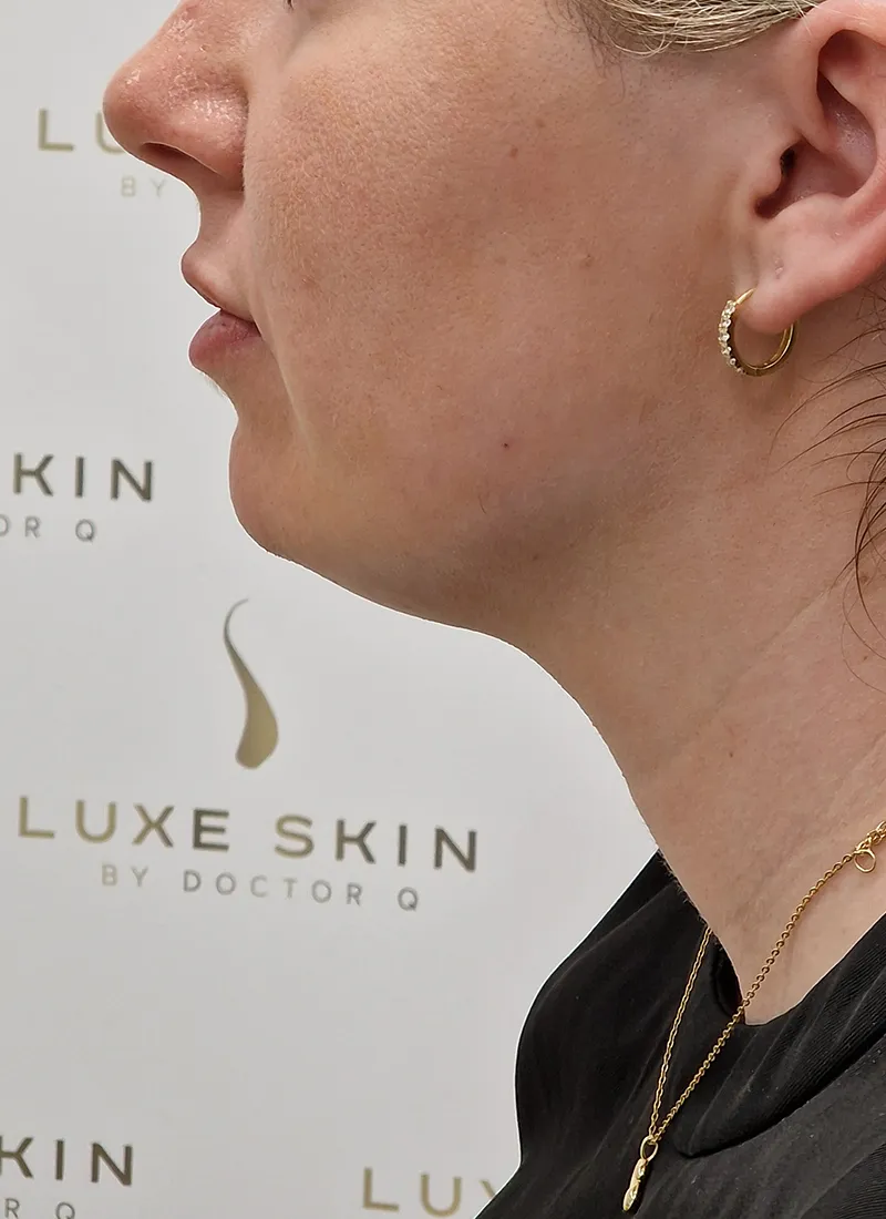 Double Chin Client Before Treatment with Dr Q