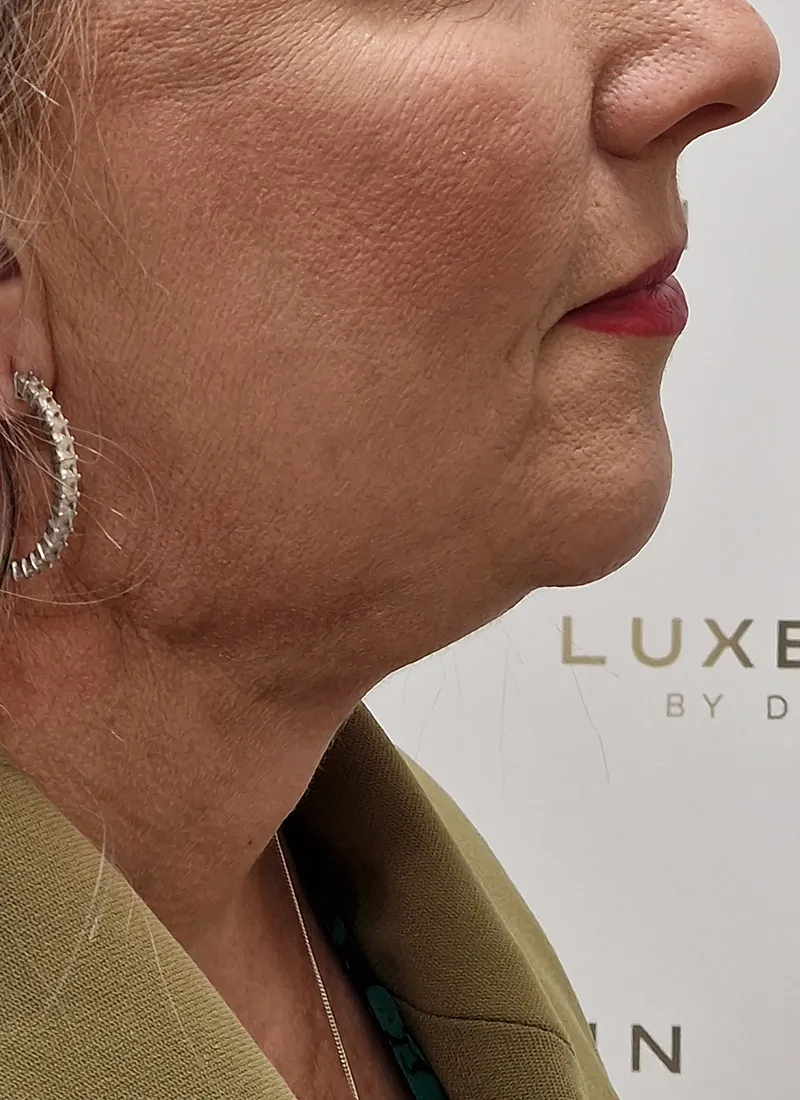 Double Chin Removal After Treatment at Luxe Skin in Glasgow