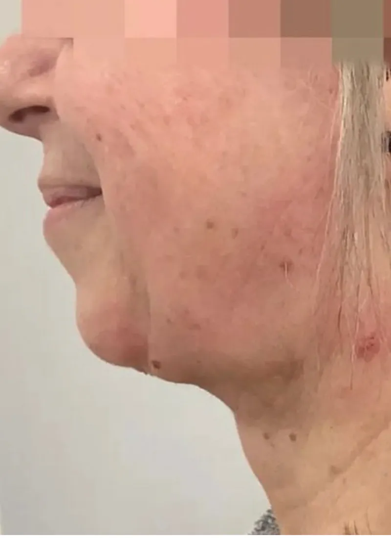 Facetite After Dr Q Glasgow