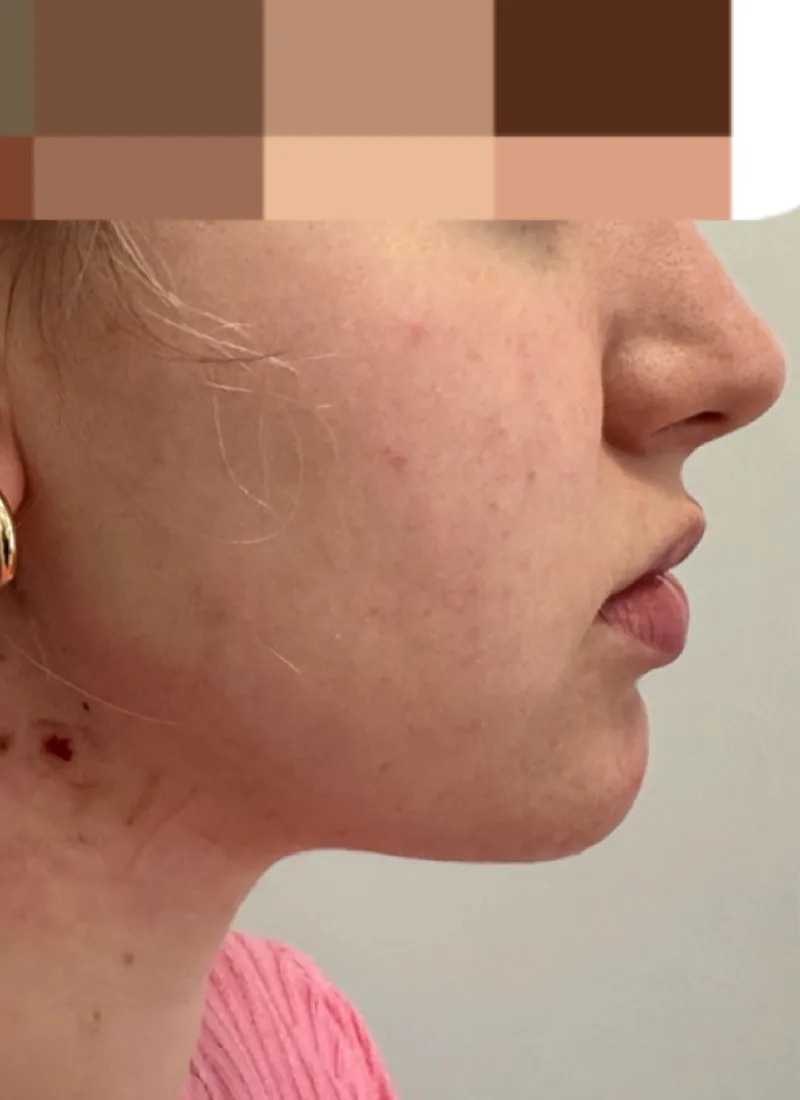 Facetite After at Luxe Skin Dr Q Glasgow