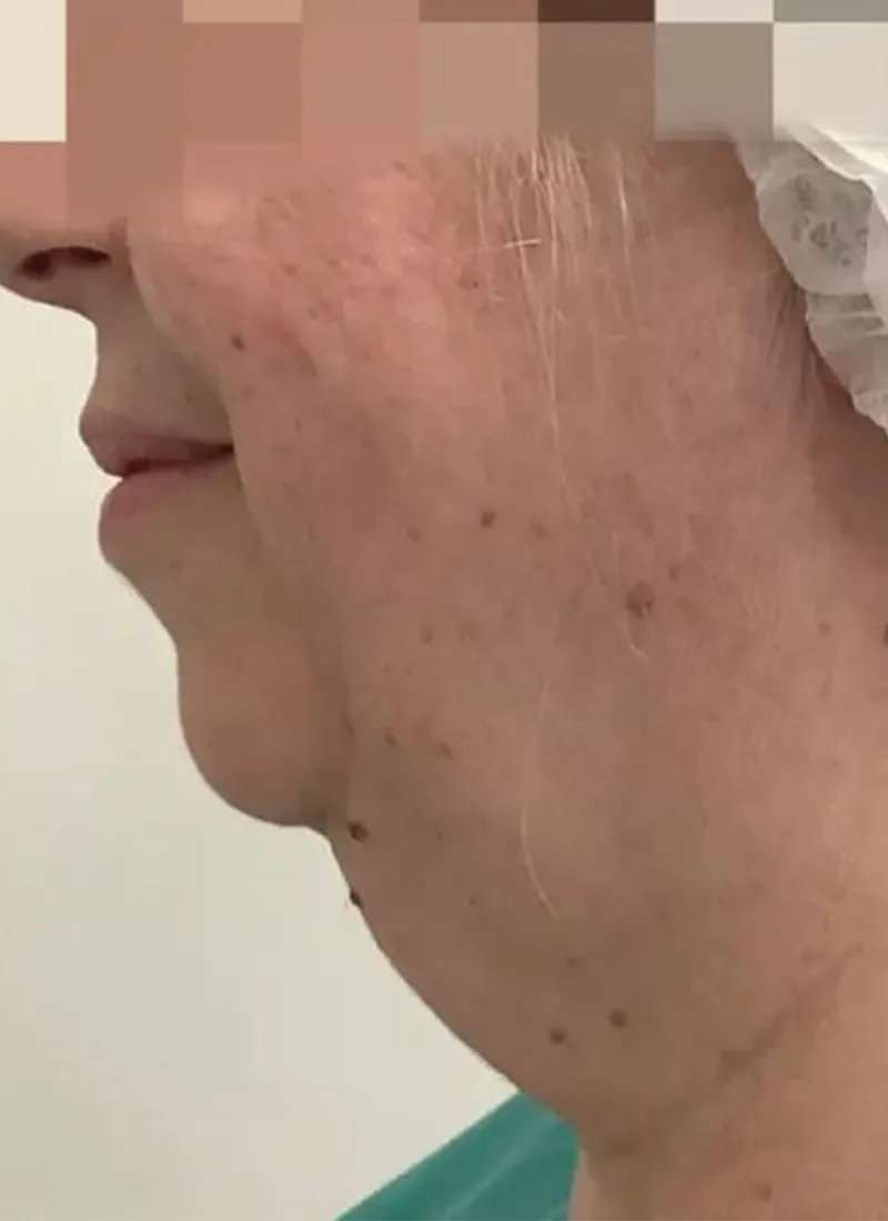 Facetite Before Dr Q Glasgow