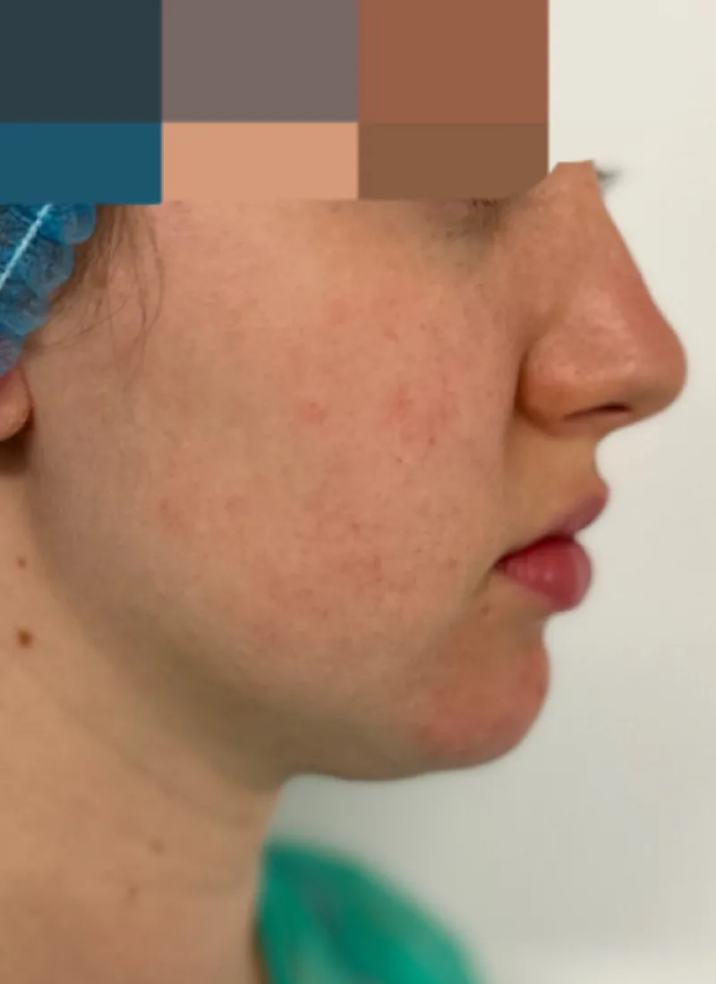 Facetite Before at Luxe Skin Dr Q Glasgow