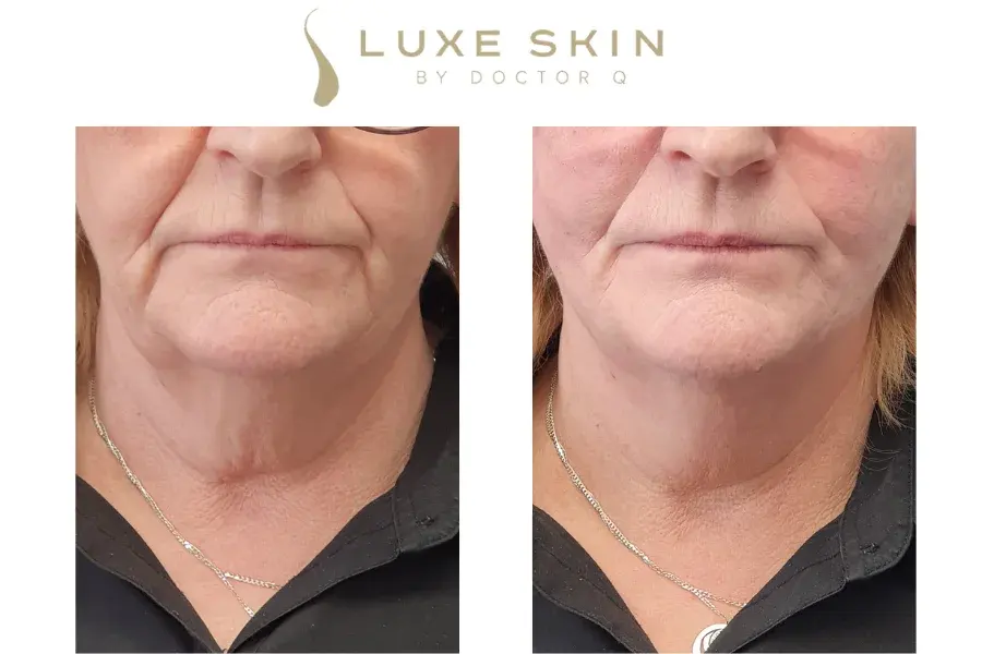 Defined Jawline Without Surgery Before and After at our Clinic In Glasgow