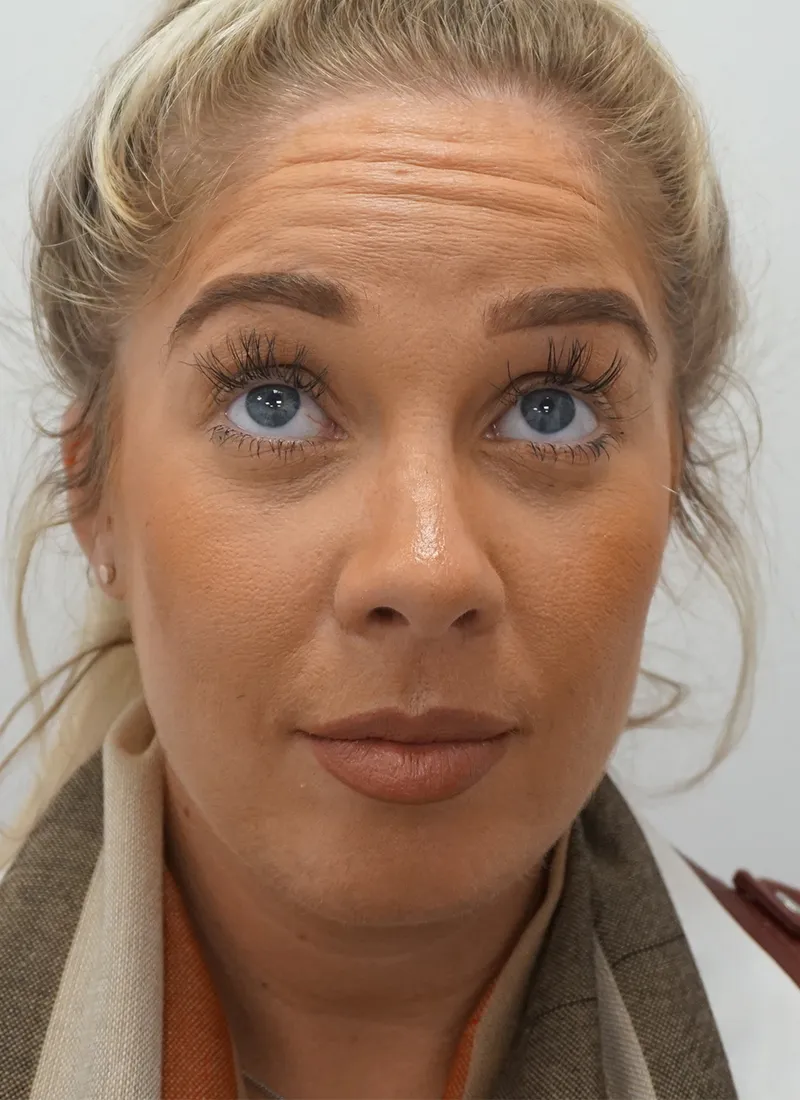 Botox Before in Glasgow by Dr Q