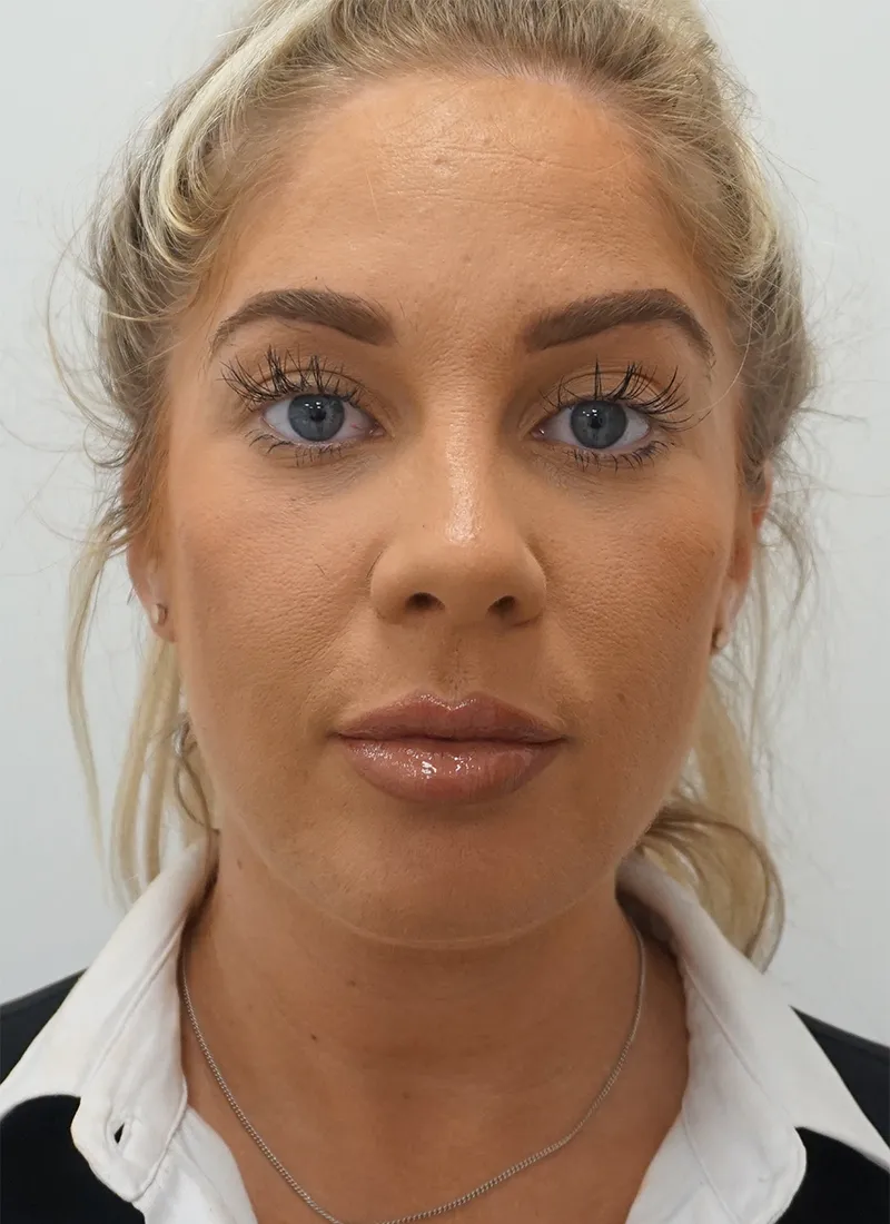 Botox After in Glasgow by Dr Q