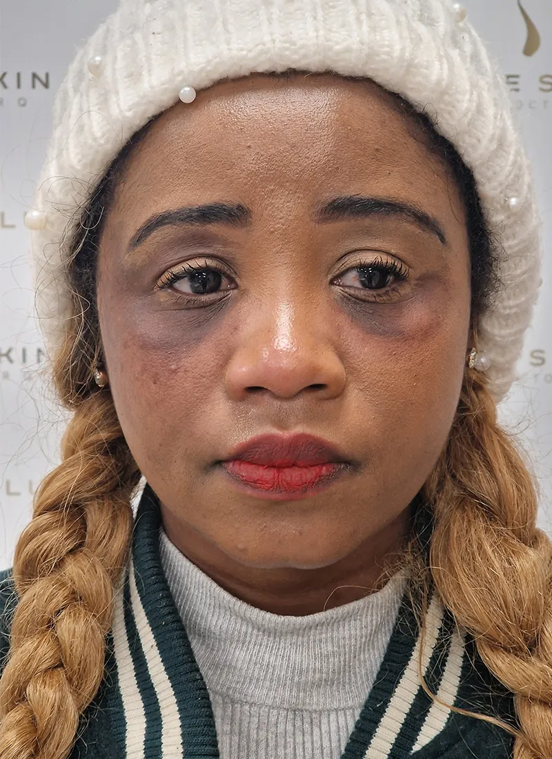 Hyperpigmentation Before at Luxe Skin by Dr Q in Glasgow