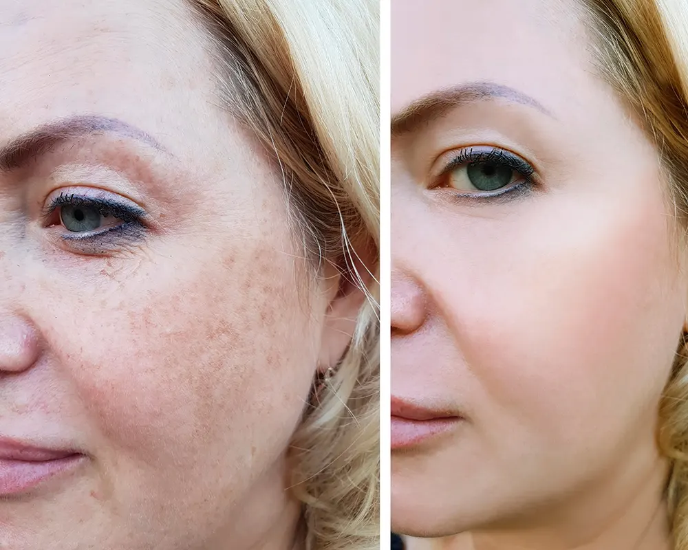 Hyperpigmentation Treatment Glasgow