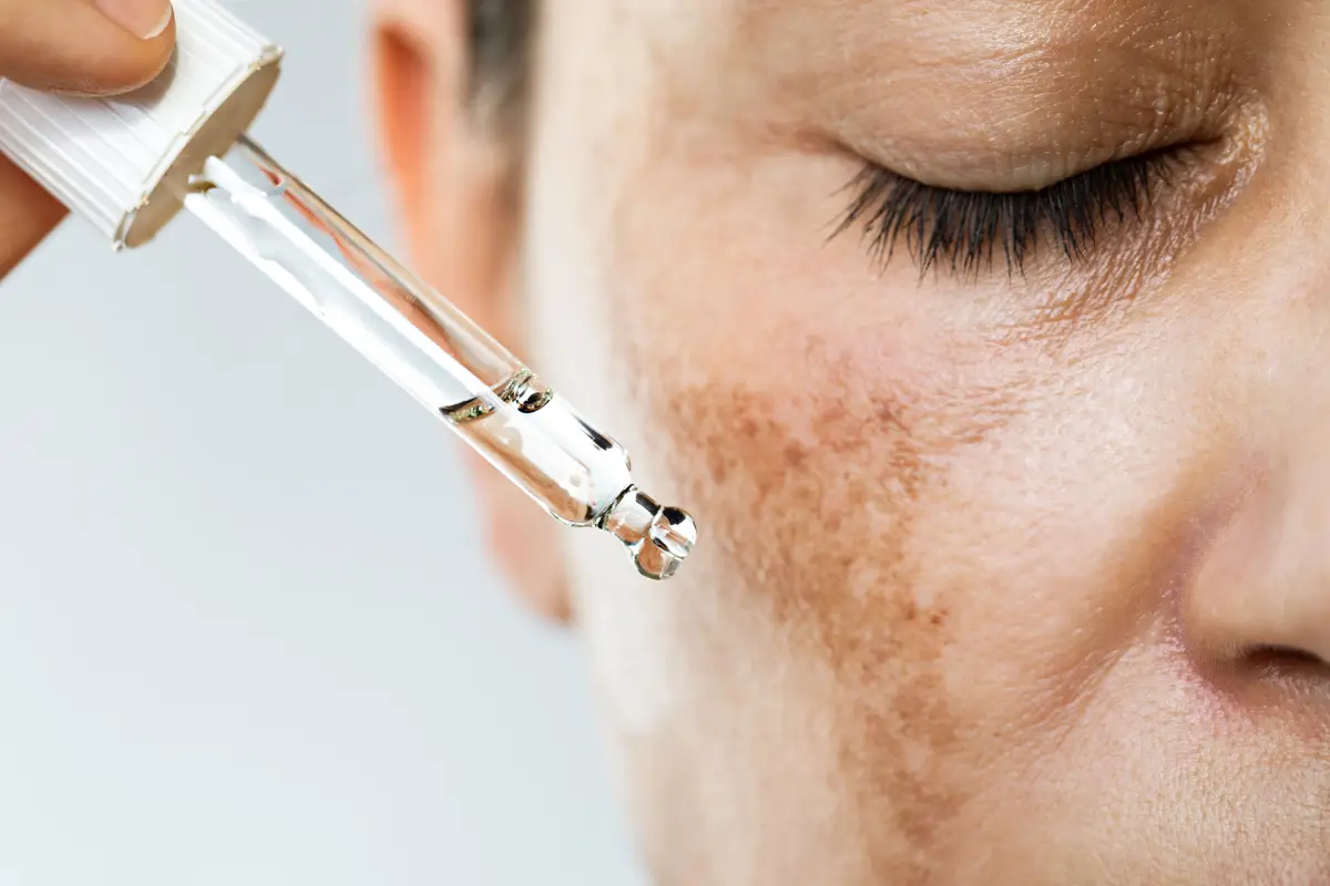Hyperpigmentation Myths