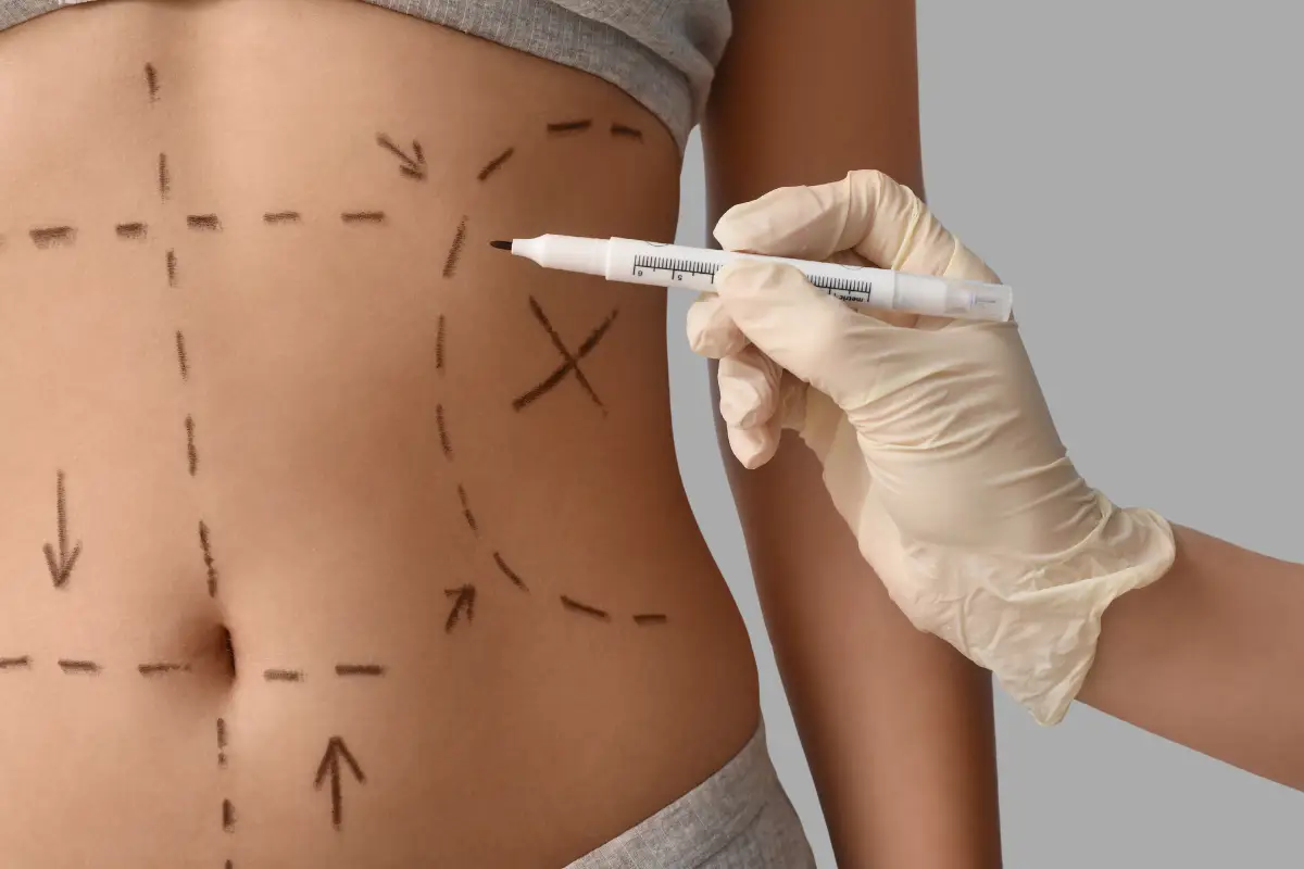 The Biology of Body Contouring: How Liposuction Permanently Alters Fat Distribution
