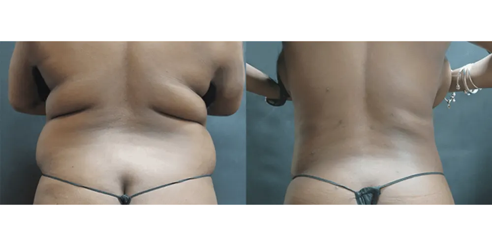 Liposuction abdomen before and after at our glasgow clinic luxe skin by dr q