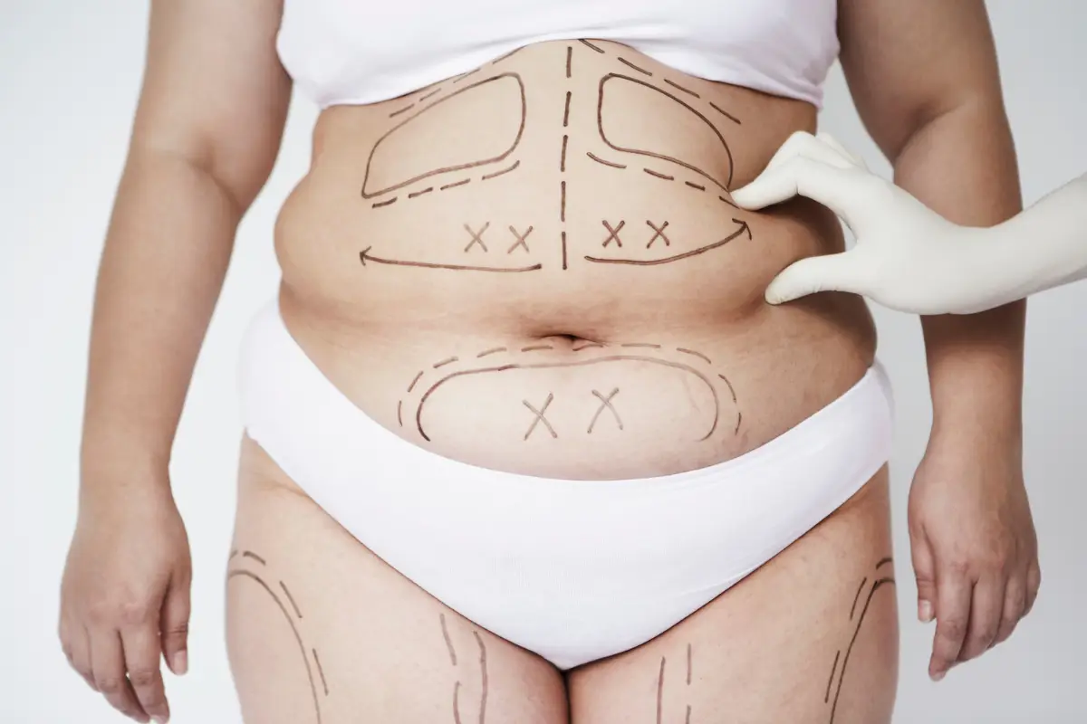 liposuction correct way of doing it