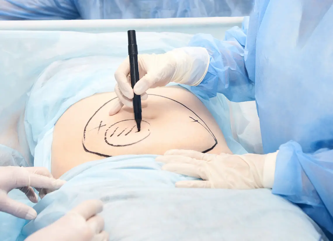 Liposuction in Glasgow: Dr. Q's Advanced Techniques for Natural Body Contouring