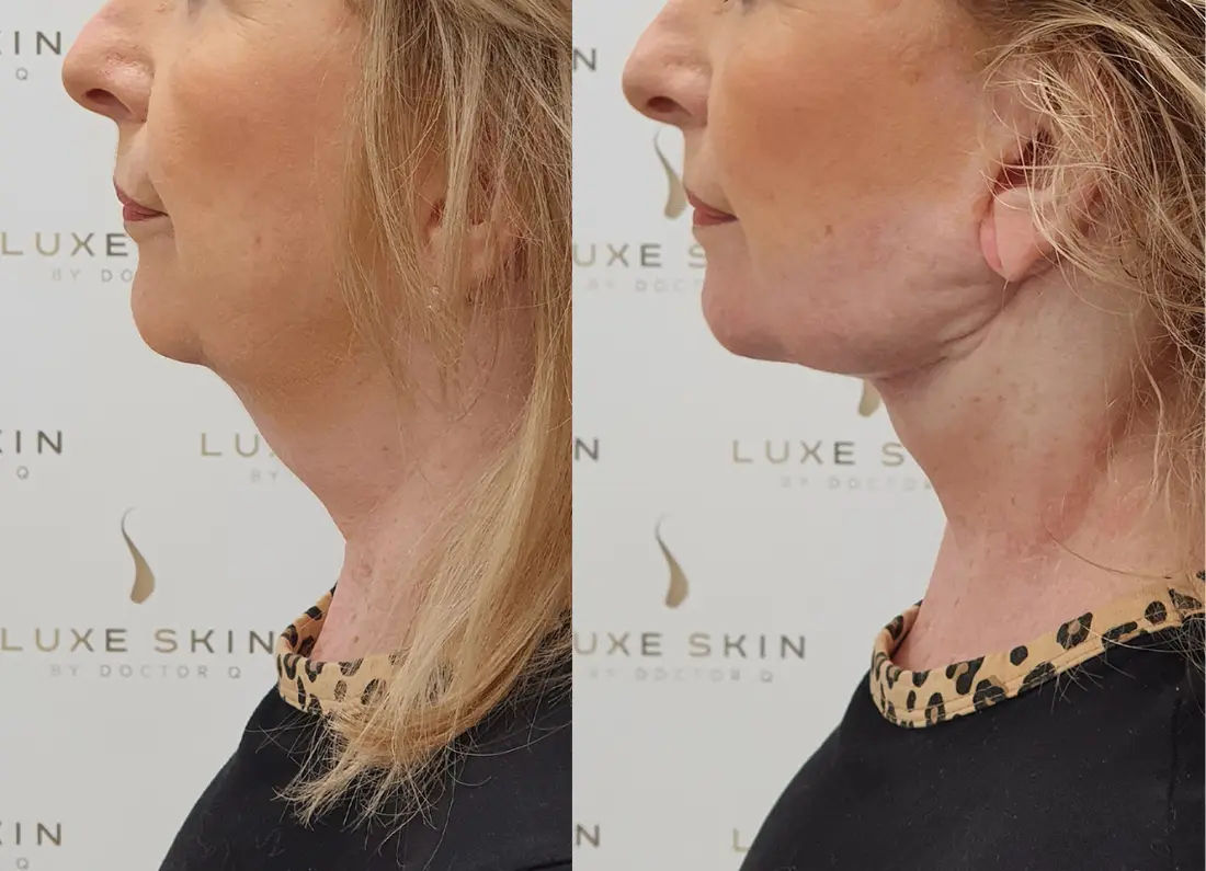 Natural facial rejuvenation before and after