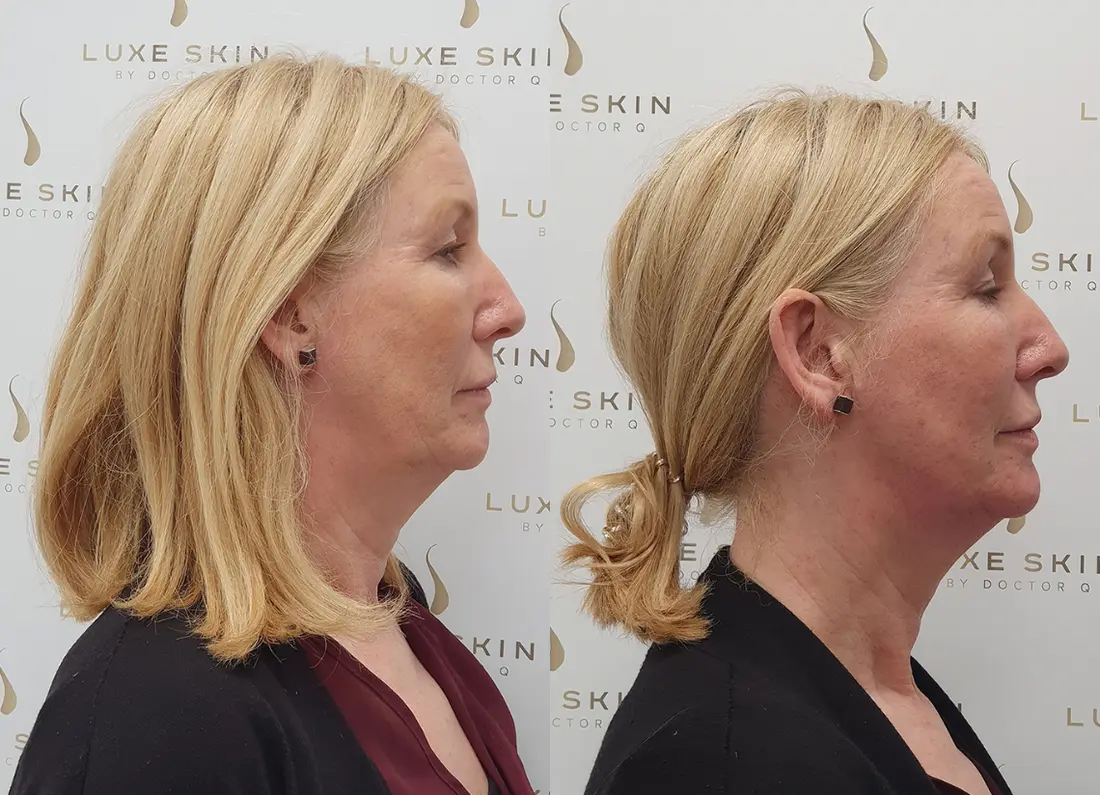 Before and after aesthetic treatment in Glasgow by Dr Q