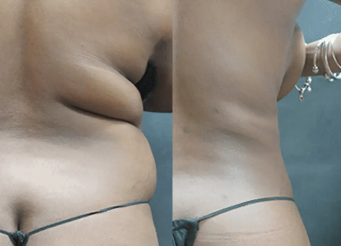 Before and after non surgical cosmetic procedure