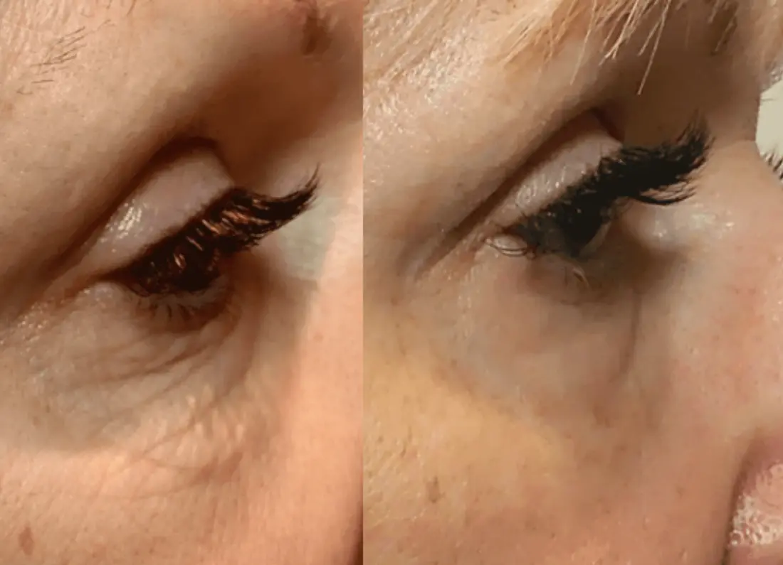 Patient facial enhancement results at Luxe Skin