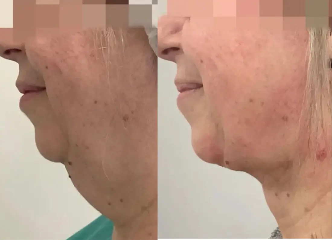 Visible improvement after advanced aesthetic treatment