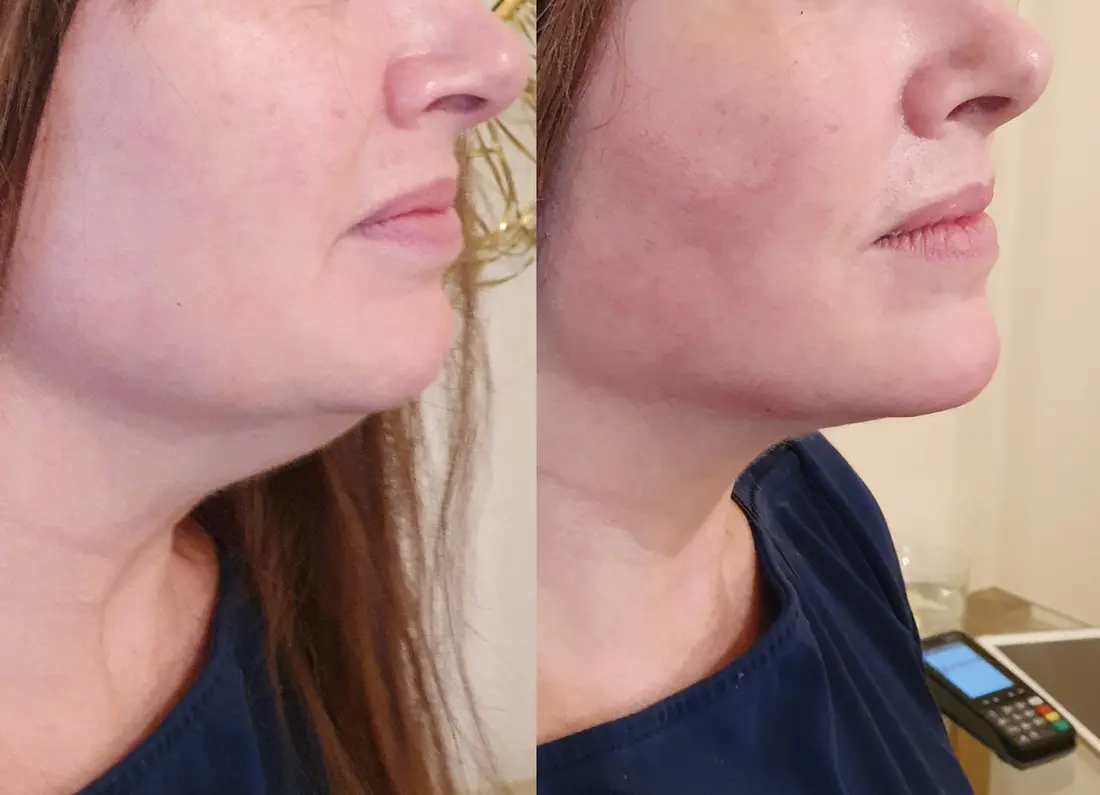 Before and after subtle, natural cosmetic rejuvenation