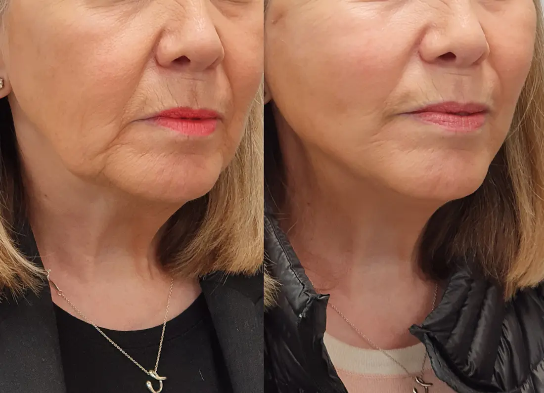 Before and after showcasing refined aesthetic results