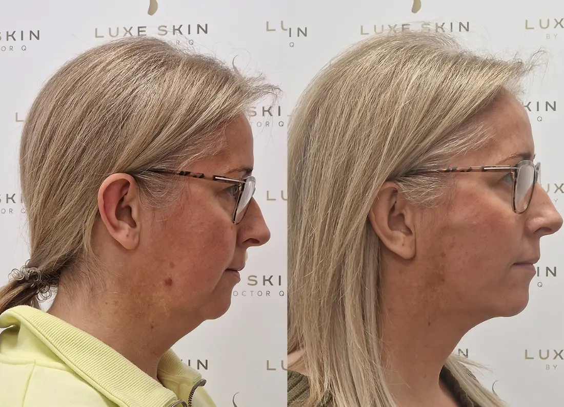 Patient transformation following minimally invasive treatment