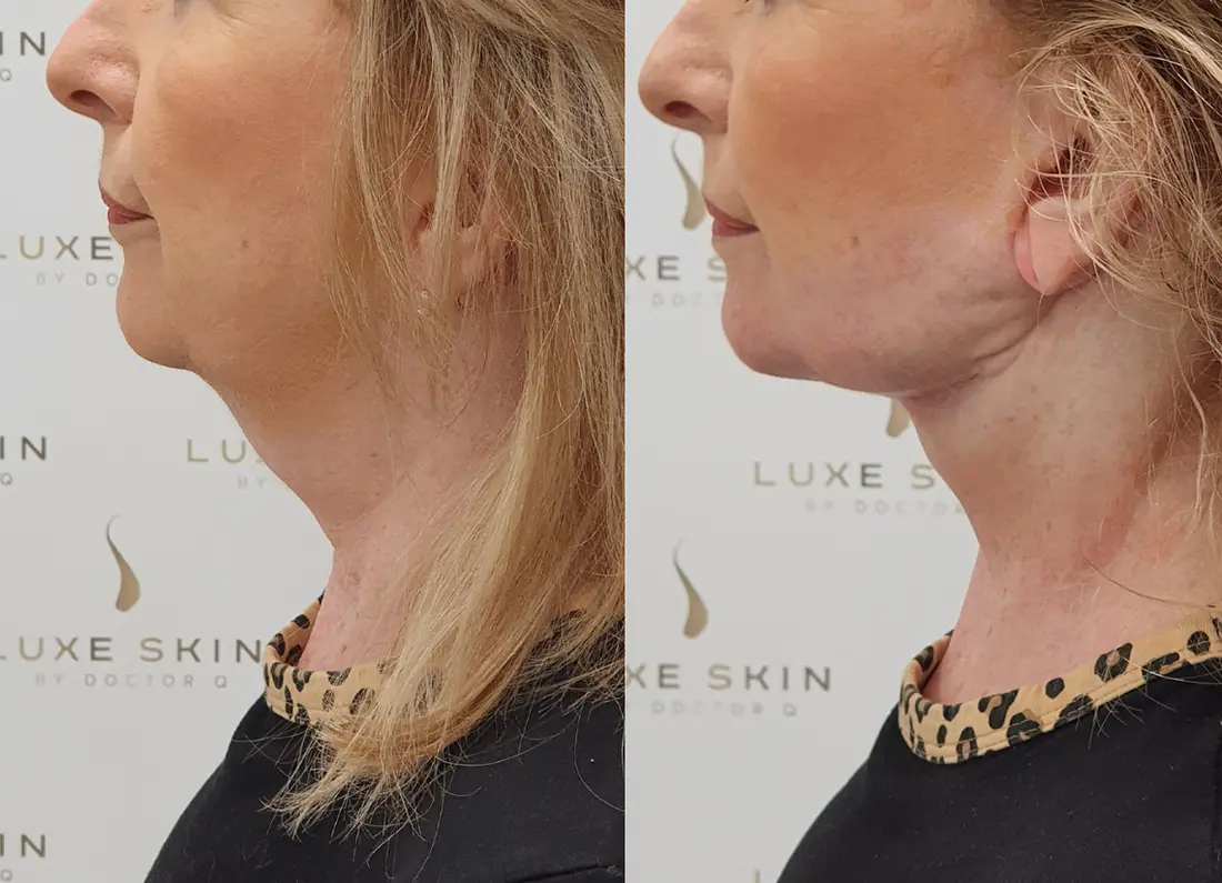 Natural look enhancement before and after at Luxe Skin Glasgow