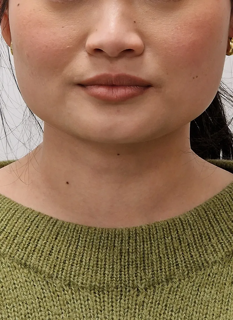 Masseter Botox After treatment at Luxe Skin Glasgow