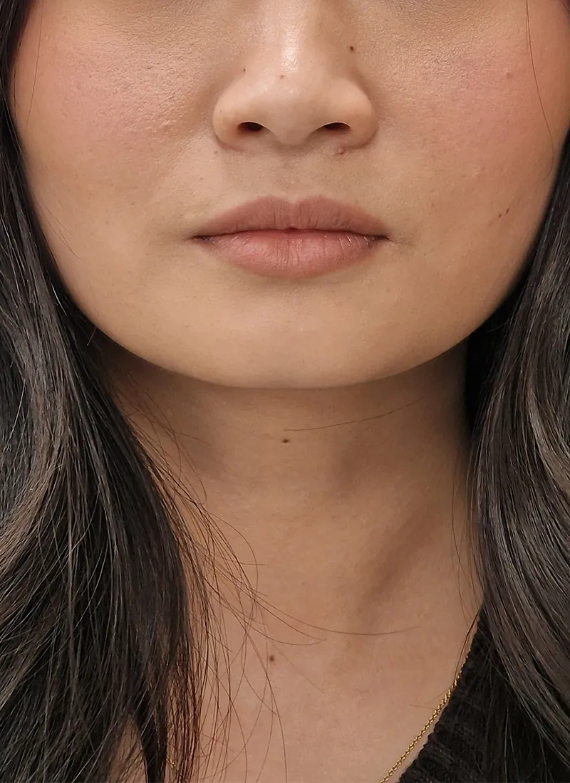 Masseter Botox Before Treatment At Luxe Skin Glasgow